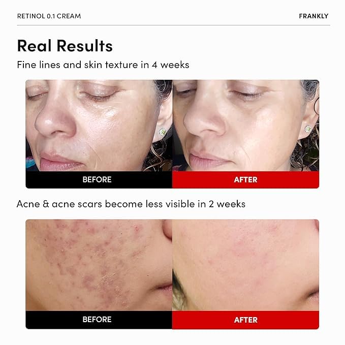 FRANKLY Retinol 0.1% Cream side view with ingredient list
