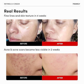 FRANKLY Retinol 0.1% Cream side view with ingredient list