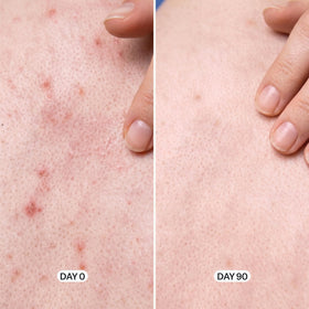 Geologie Acne Control Body Wash showing ingredients list