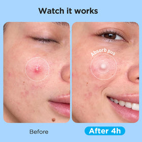Glowpatch Hydrocolloid Pimple Patches on skin