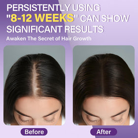 Greoay Minoxidil Foam bottle side view showing dosage pump