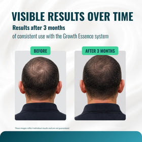 Growth Essence Minoxidil 5% Cream side view