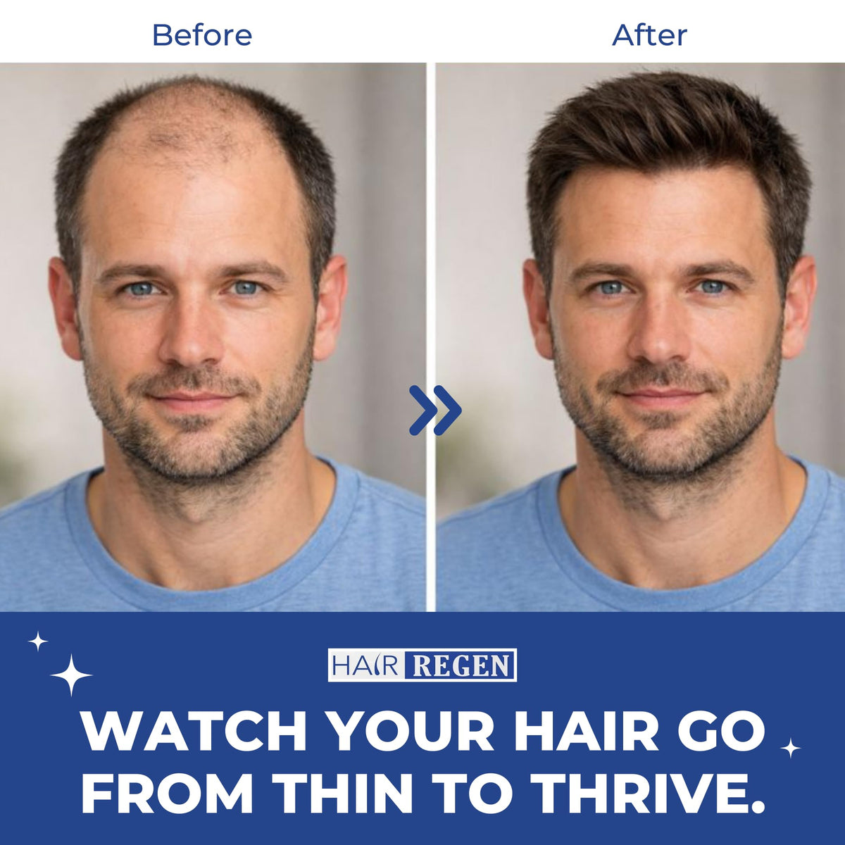 Hair Regen Minoxidil 5% with derma roller lifestyle scene