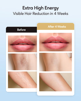 INNZA IPL Hair Removal Device in use on arm
