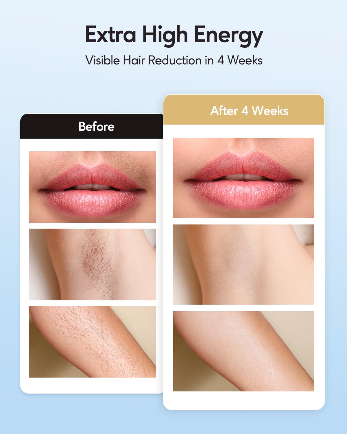 INNZA IPL Hair Removal device in use on leg with ice cooling