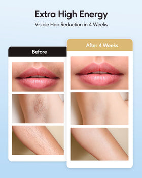 INNZA IPL Hair Removal device in use on leg with ice cooling