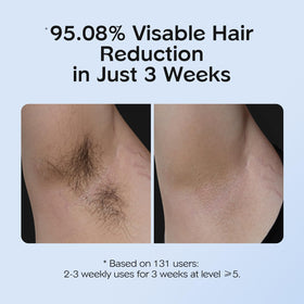 INNZA IPL Hair Removal Device in use on legs