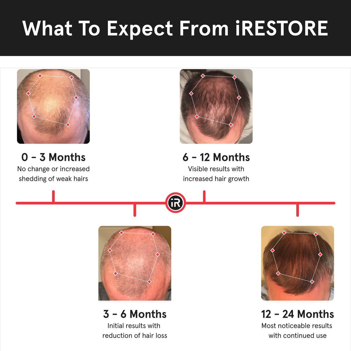 iRestore Essential Laser Hair Growth Cap back view