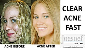 JOESOEF Sulfur Acne Soap 100g close-up