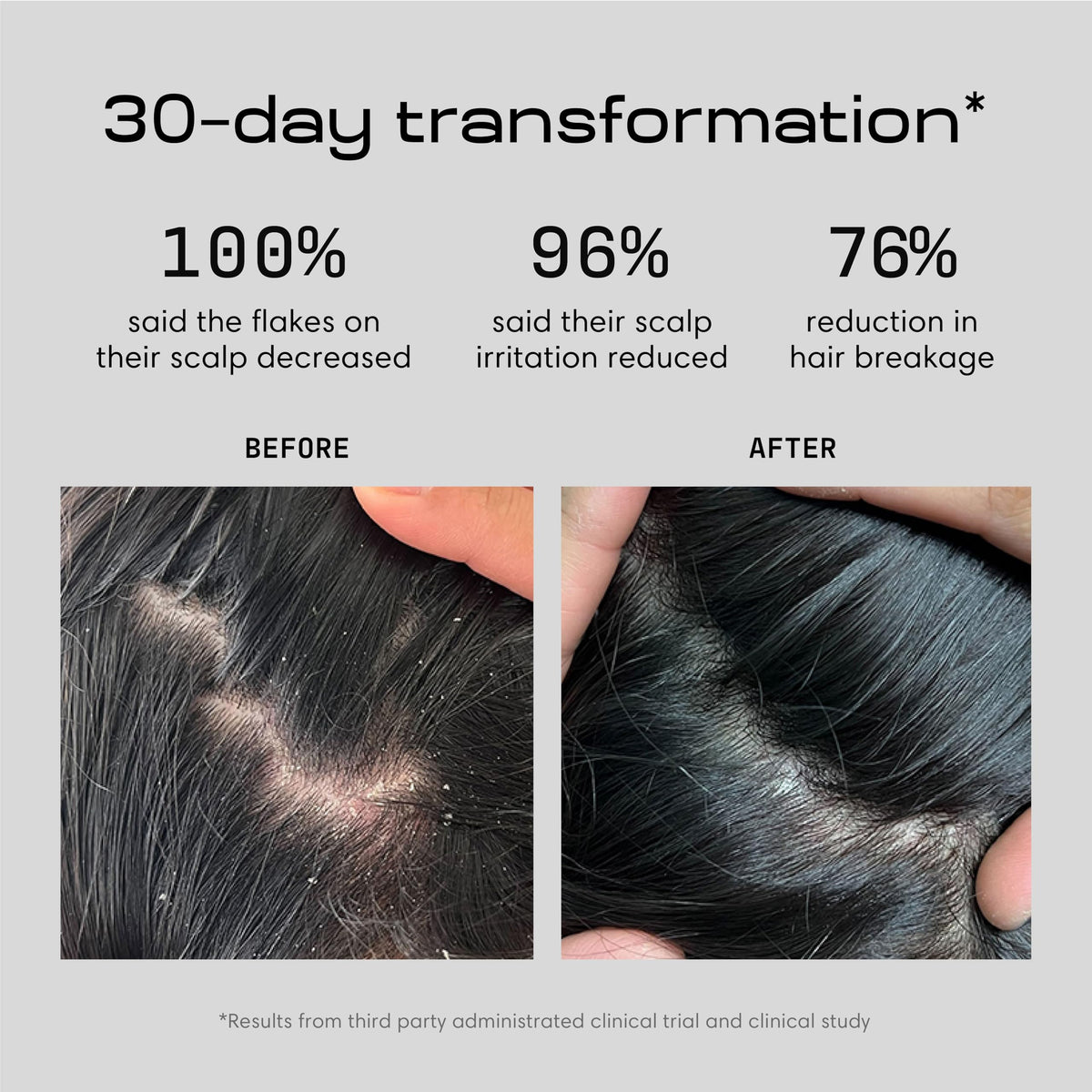 Jupiter Anti Dandruff Shampoo 472g side view