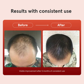 Keeps Minoxidil Solution 5% dropper application