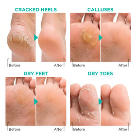 Lavinso Foot Peel Mask application on feet in a bath