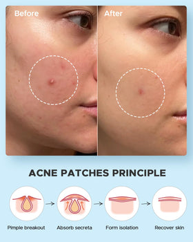 Lifestyle image of LitBear Acne Pimple Patches in use