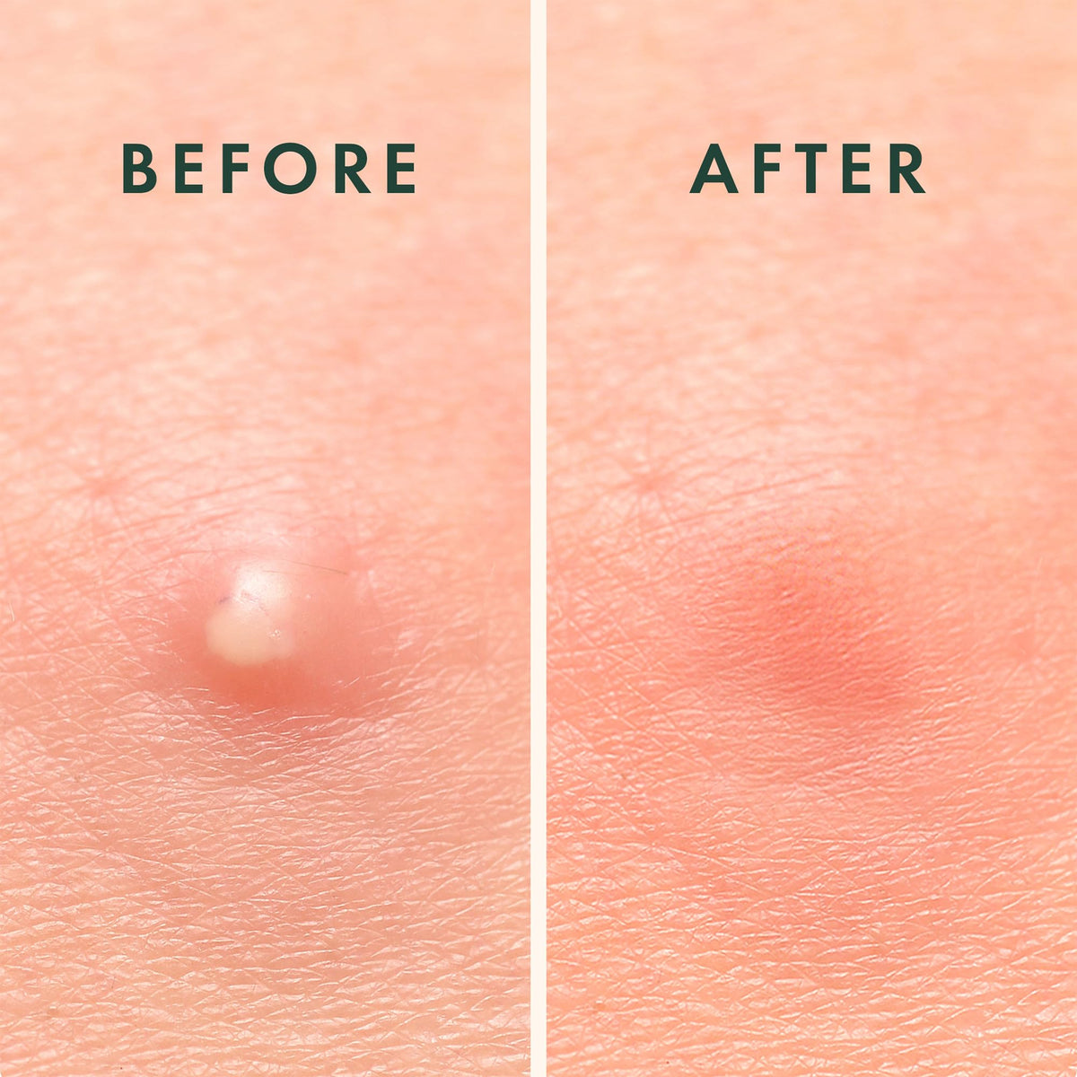 Lifestyle image of Rael Miracle Overnight Spot Cover Patches