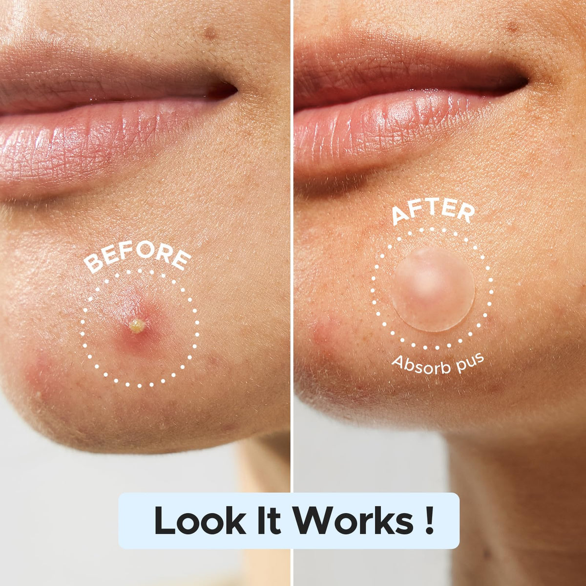 LitBear pimple patches displayed on a clean surface