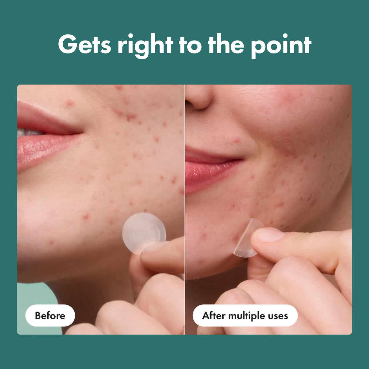 Mighty Patch Micropoint Acne Pimple Patches display with 8 patches