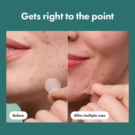 Mighty Patch Micropoint Acne Pimple Patches display with 8 patches