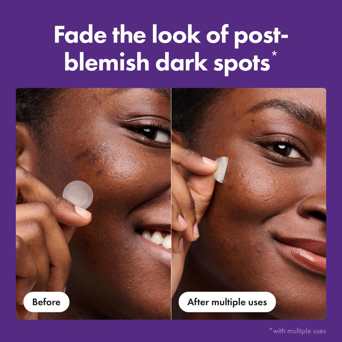 Mighty Patch Post-Blemish Patches on skin demonstration