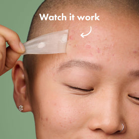 Mighty Patch Surface Large Acne Pimple Patches back view with details
