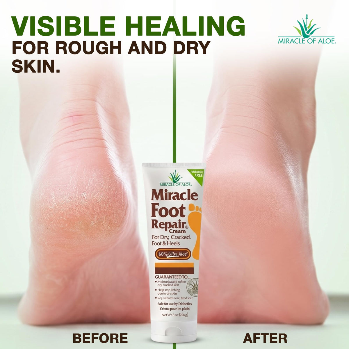 Miracle of Aloe Foot Repair Cream application on feet