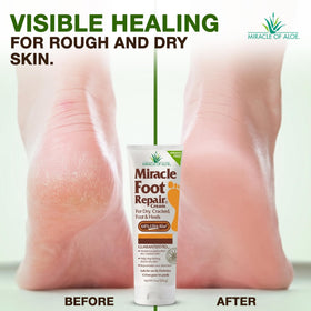 Miracle of Aloe Foot Repair Cream application on feet