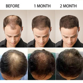 MQN 5% Minoxidil Hair Growth Scalp Massage Cream ingredients list