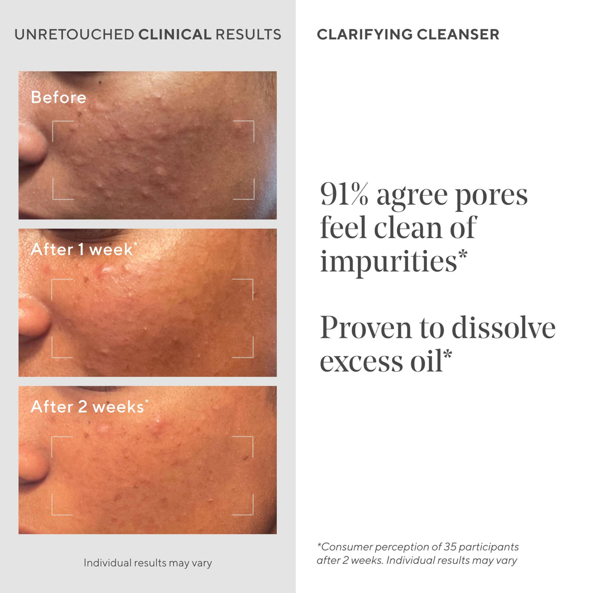 Murad Acne Control Clarifying Cleanser 16.9 Fl Oz with pump