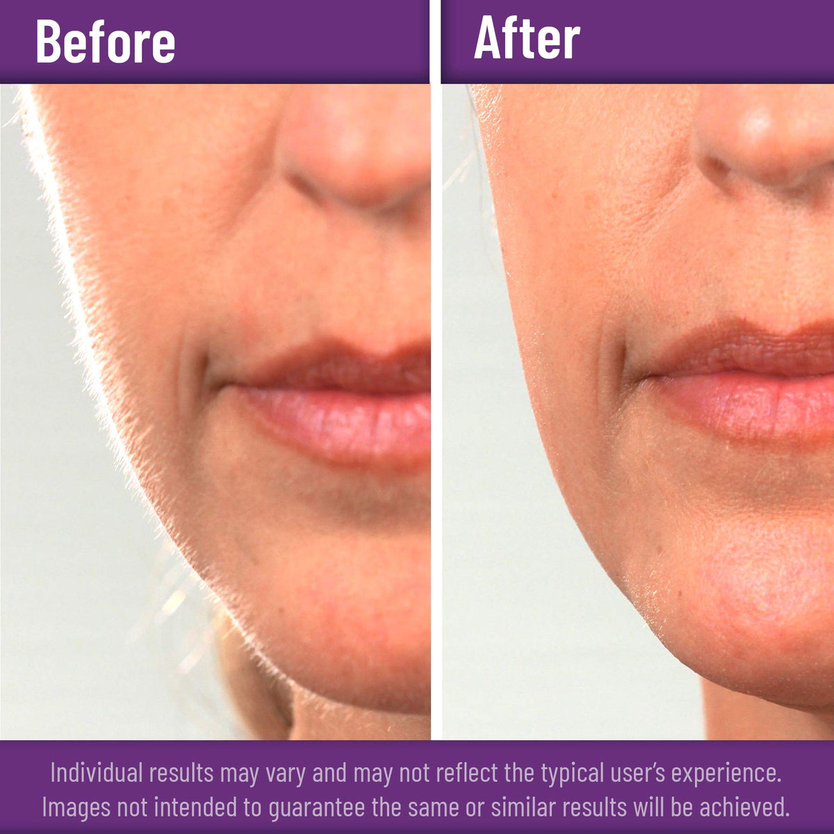 MyMed Disposable Scalpel Blades #15 for aesthetic procedures