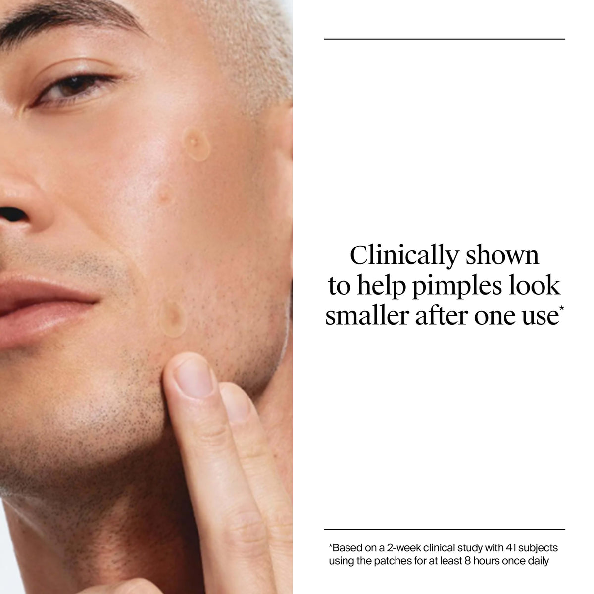 Neutrogena Stubborn Acne Patches displayed next to skincare products