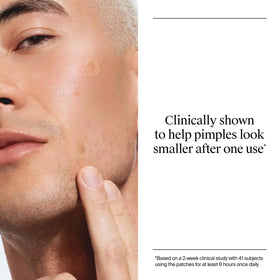 Neutrogena Stubborn Acne Patches displayed next to skincare products