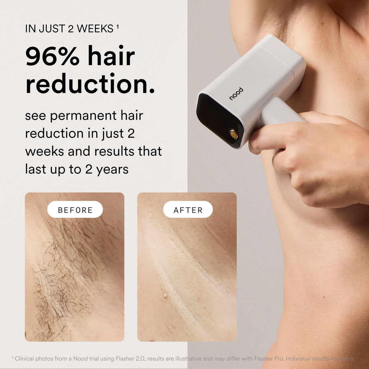 Nood Flasher Pro IPL Laser Hair Removal Device packaging