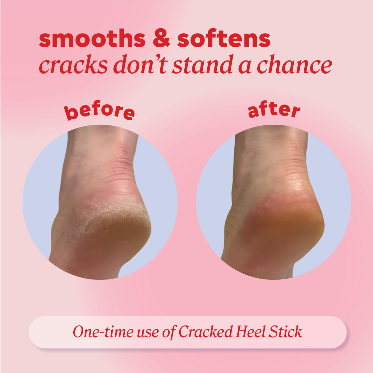 Onyx Professional Cracked Heel Repair Balm Stick applied on dry cracked heel