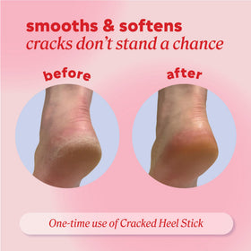 Onyx Professional Cracked Heel Repair Balm Stick applied on dry cracked heel