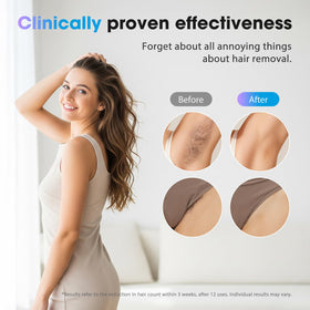 Oreeth IPL Laser Hair Removal Device showing cooling contact feature