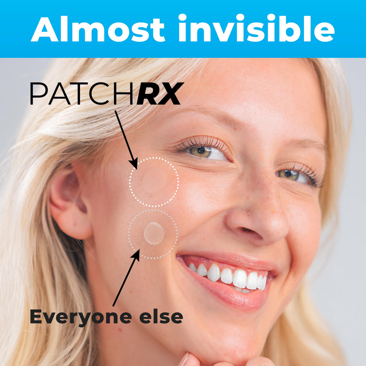 PatchRx Pimple Patches applied on skin