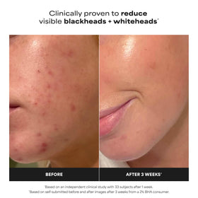 Paula's Choice Skin Perfecting 2% BHA Liquid Exfoliant 1oz with cap off