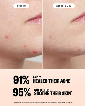 PEACE OUT Acne Healing Dots displayed on a bathroom counter