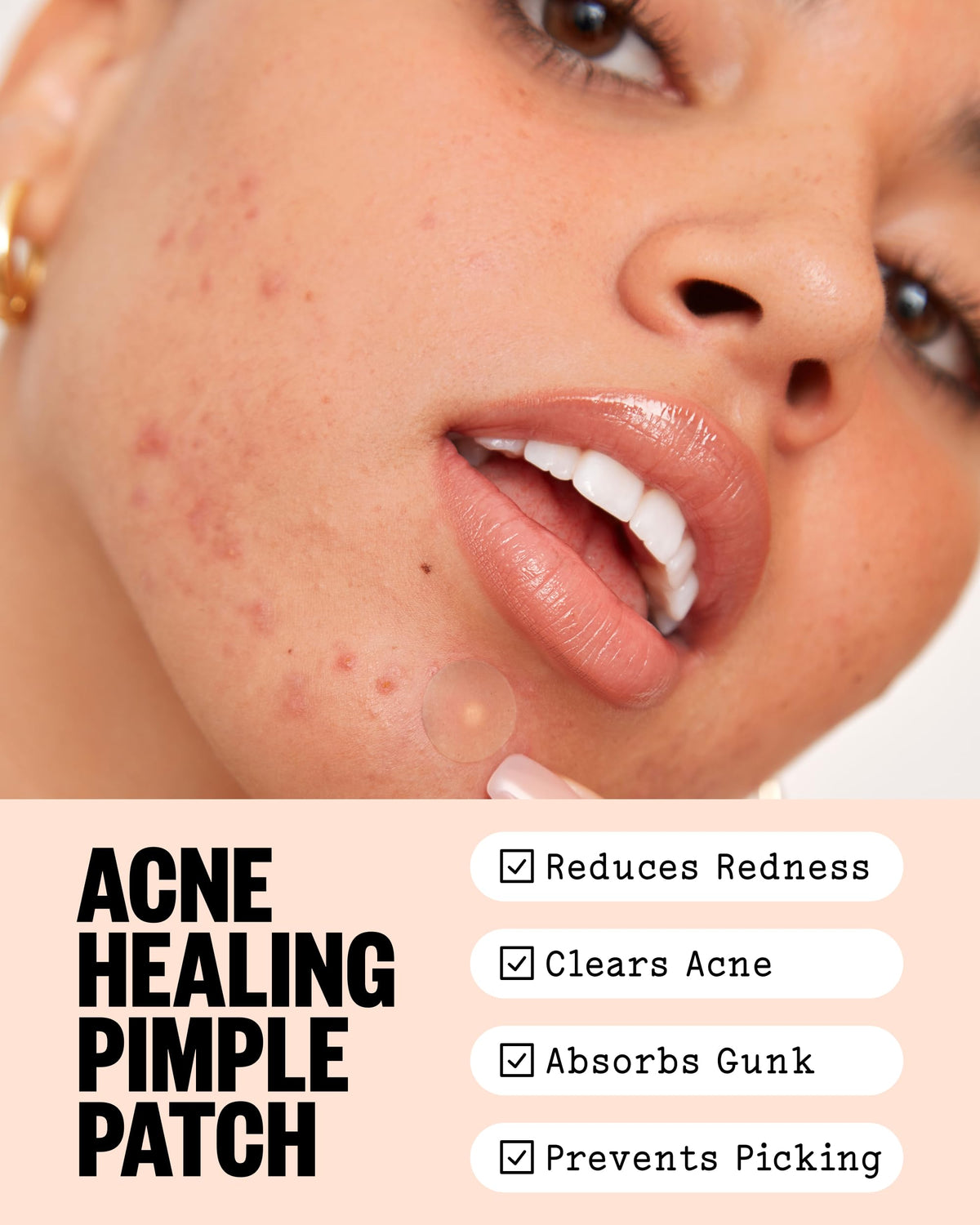 PEACE OUT Acne Healing Dots patches on a hand
