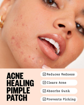 PEACE OUT Acne Healing Dots patches on skin