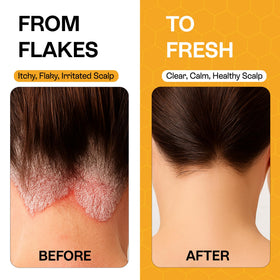 Pharmlitalia Psoriasis Shampoo 200ml with ingredients list
