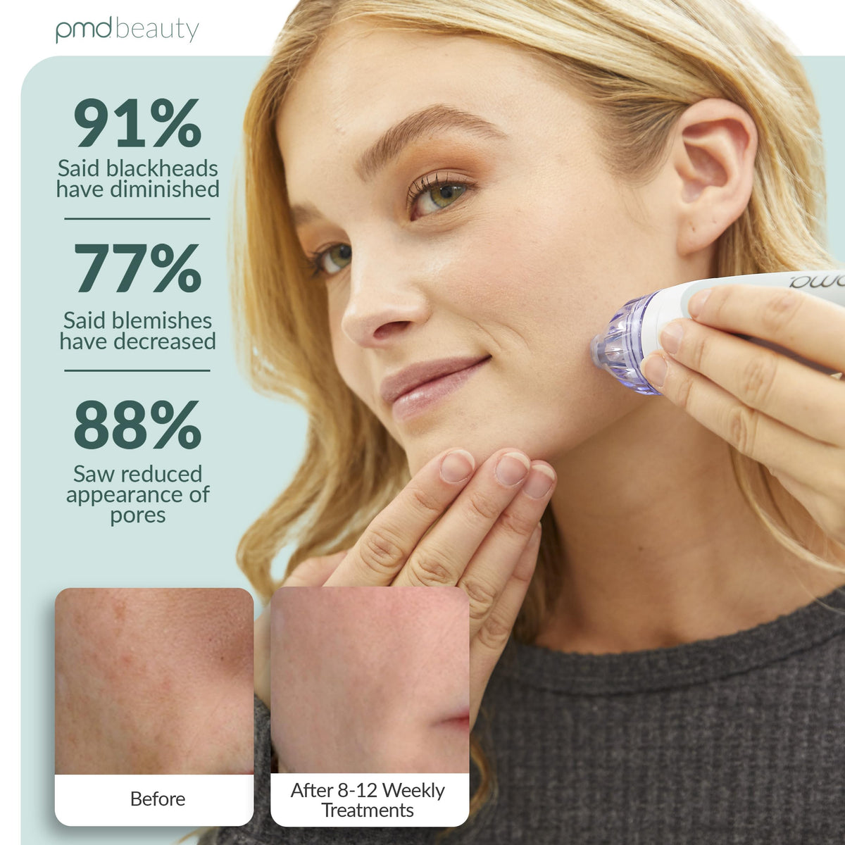 PMD Beauty Personal Microderm Classic with included accessories