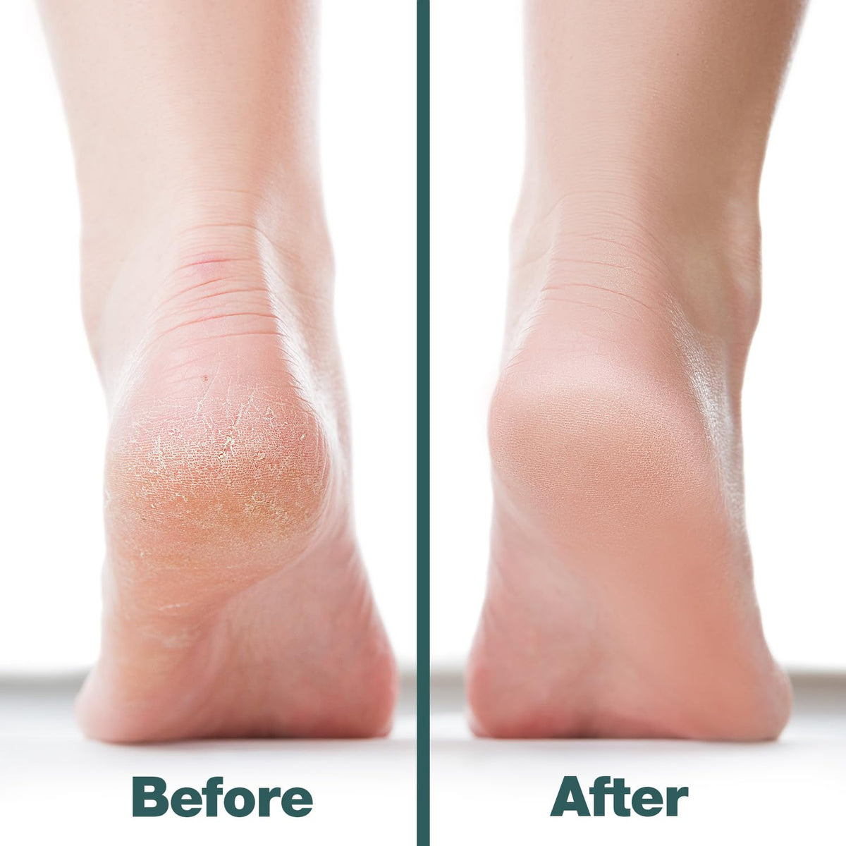 Probelle foot file in use on cracked heels