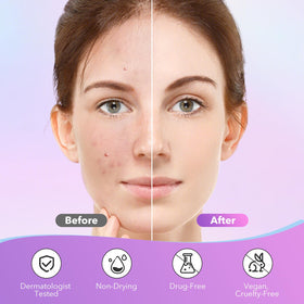 QUSTERE Pimple Patches pack with pink and purple patches