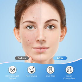 QUSTERE Pimple Patches with natural ingredients