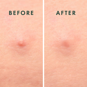 Rael Hydrocolloid Pimple Patches displayed with skincare products