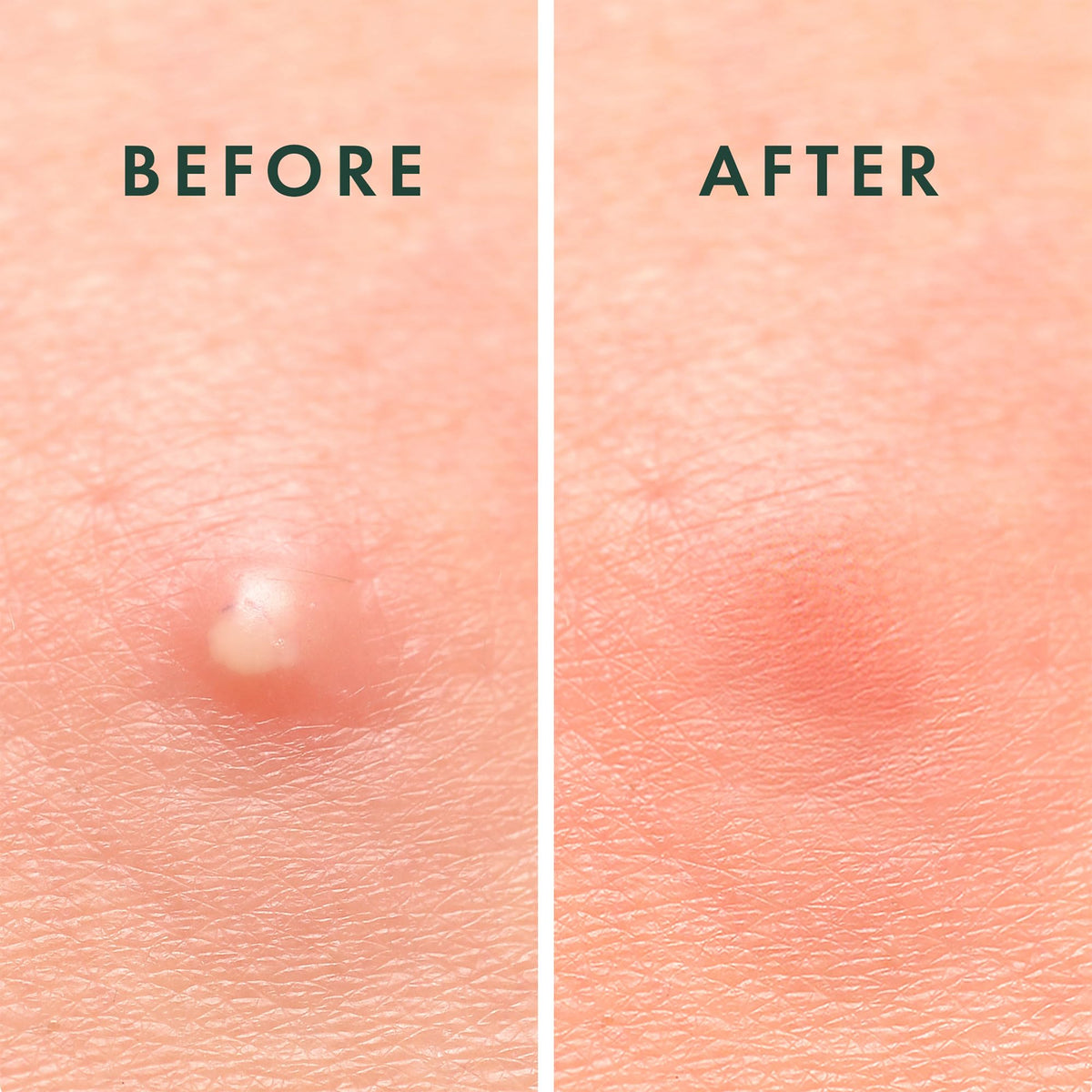 Rael Miracle Invisible Spot Cover Patches lifestyle use