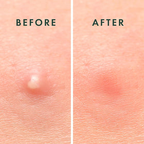 Rael pimple patches with microcrystal detail