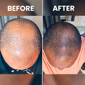 RENNORA BEAUTY Hair Growth Serum application process