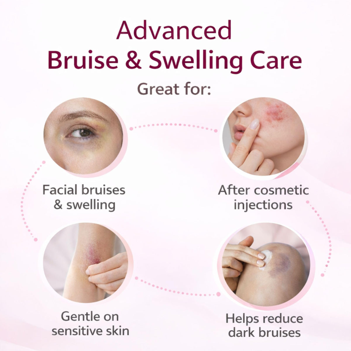 RMCYDS Arnica Bruise Cream application on skin