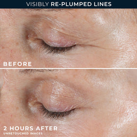 RoC Retinol Correxion Forehead Wrinkle Patches in use on forehead